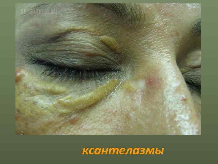 ксантелазмы 