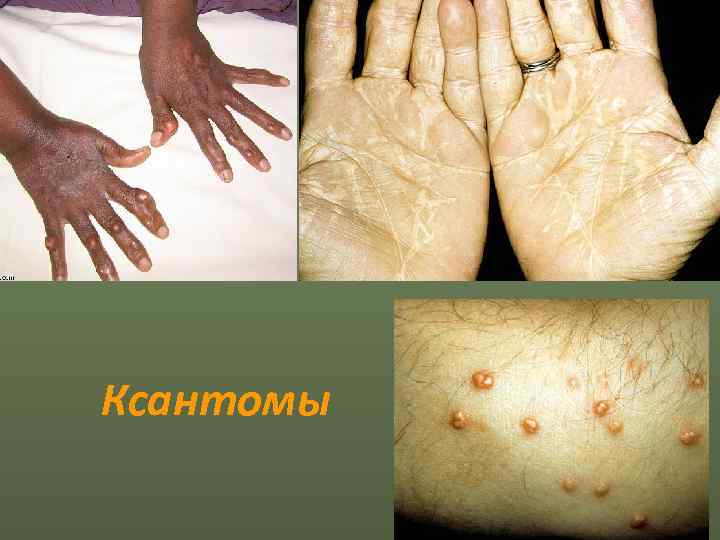 Ксантомы 