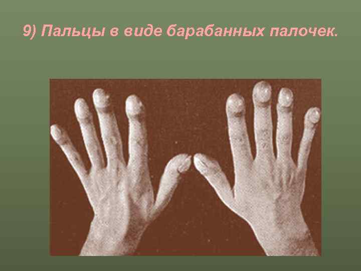 9) Пальцы в виде барабанных палочек. 