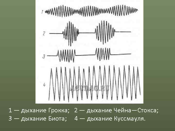 1 — дыхание Грокка; 2 — дыхание Чейна—Стокса; 3 — дыхание Биота; 4 —