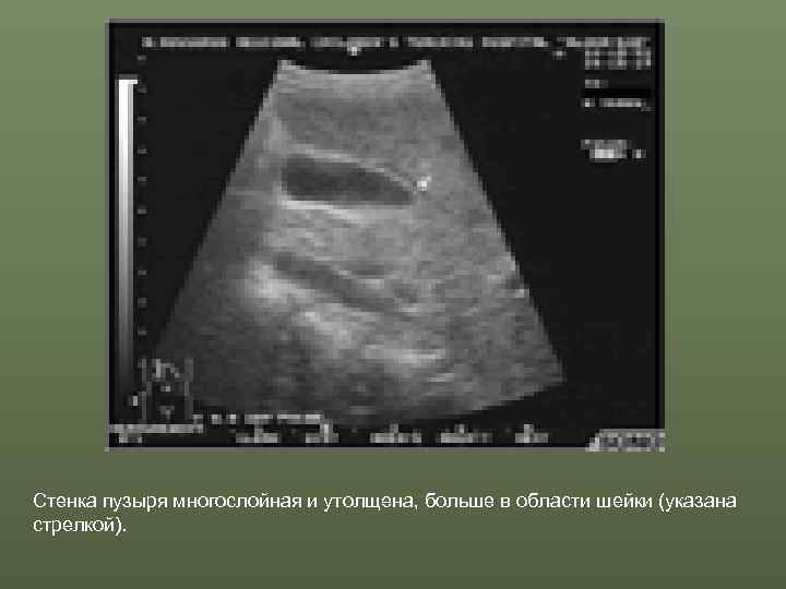 Стенка пузыря многослойная и утолщена, больше в области шейки (указана стрелкой). 