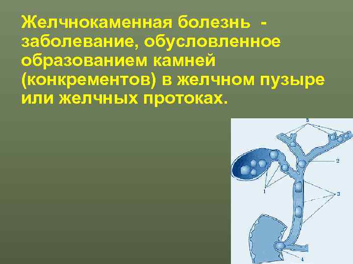 Желчнокаменная болезнь - заболевание, обусловленное образованием камней (конкрементов) в желчном пузыре или желчных протоках.