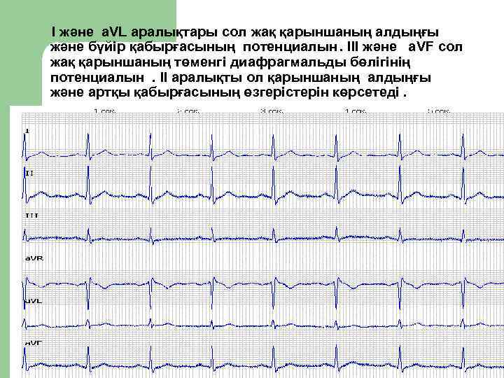 I және a. VL аралықтары сол жақ қарыншаның алдыңғы және бүйір қабырғасының потенциалын. III