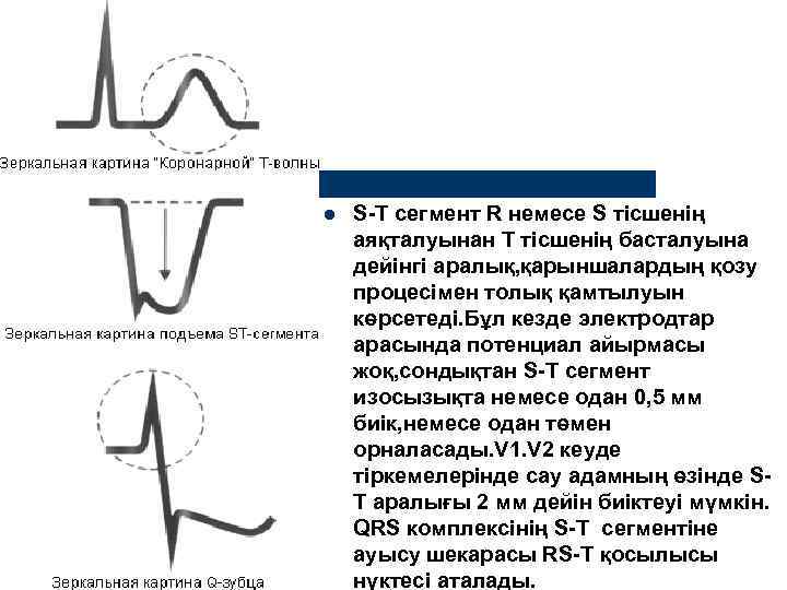 l  S-Т сегмент R немесе S тісшенің аяқталуынан Т тісшенің басталуына дейінгі аралық,