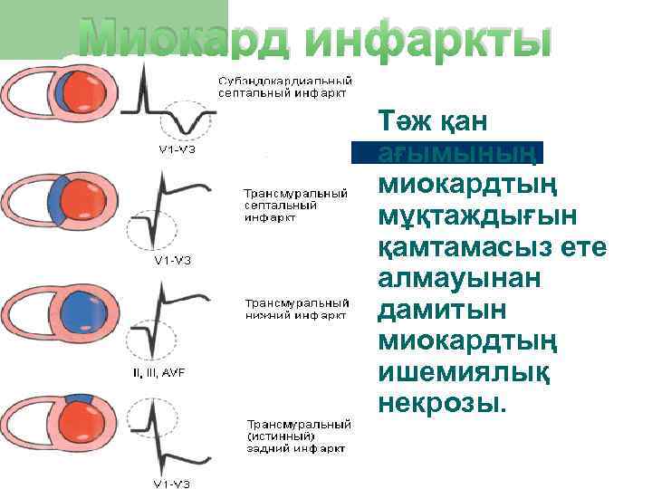 Миокард инфаркты  Тәж қан  ағымының  миокардтың  мұқтаждығын  қамтамасыз ете