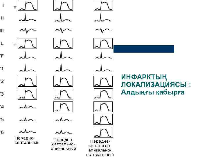ИНФАРКТЫҢ ЛОКАЛИЗАЦИЯСЫ : Алдыңғы қабырға 