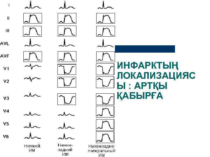 ИНФАРКТЫҢ ЛОКАЛИЗАЦИЯС Ы : АРТҚЫ ҚАБЫРҒА 