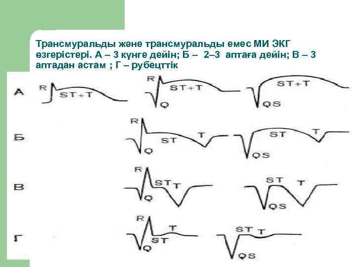 Трансмуральды және трансмуральды емес МИ ЭКГ өзгерістері. А – 3 күнге дейін; Б –