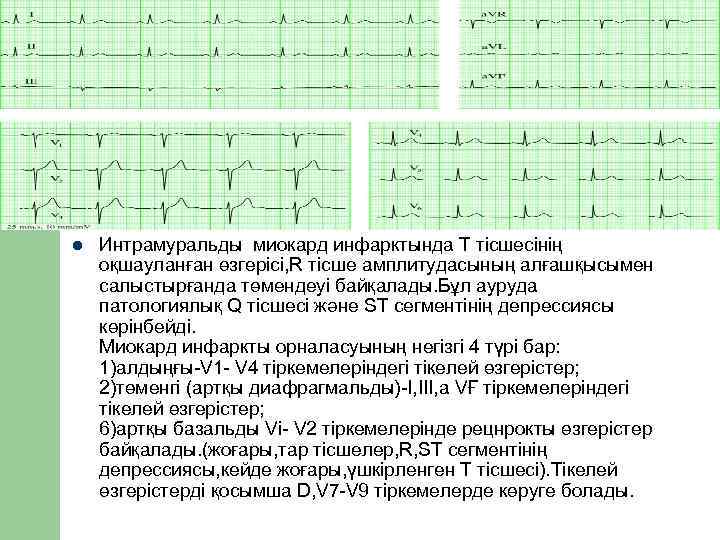 l  Интрамуральды миокард инфарктында Т тісшесінің оқшауланған өзгерісі, R тісше амплитудасының алғашқысымен салыстырғанда