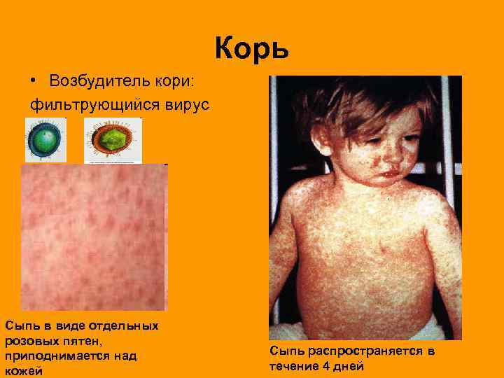      Корь • Возбудитель кори: фильтрующийся вирус Сыпь в виде