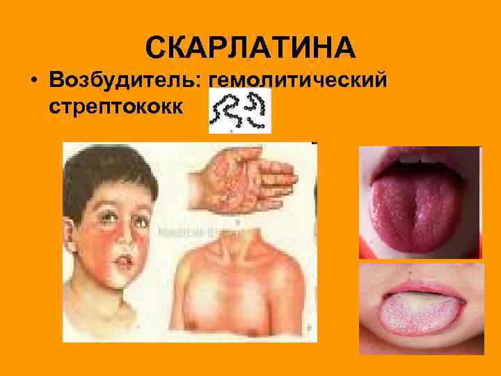   СКАРЛАТИНА • Возбудитель: гемолитический  стрептококк 