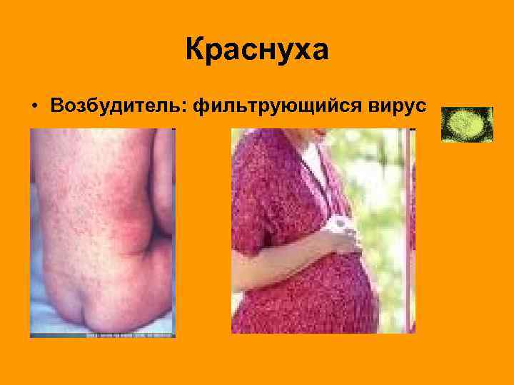    Краснуха • Возбудитель: фильтрующийся вирус 