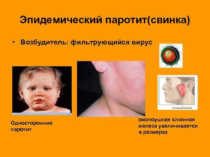  Эпидемический паротит(свинка)  • Возбудитель: фильтрующийся вирус      околоушная