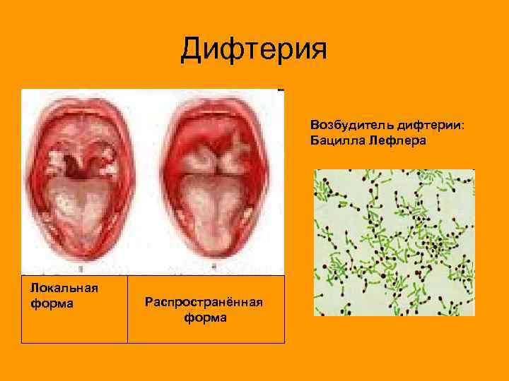     Дифтерия       Возбудитель дифтерии: 