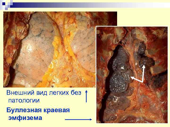Внешний вид легких без патологии Буллезная краевая эмфизема 
