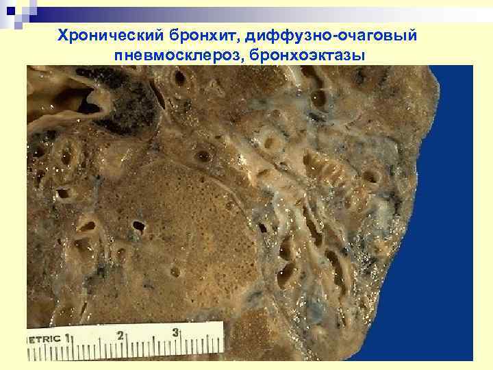 Хронический бронхит, диффузно-очаговый  пневмосклероз, бронхоэктазы 