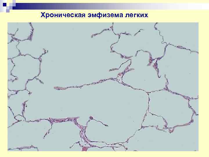 Хроническая эмфизема легких 