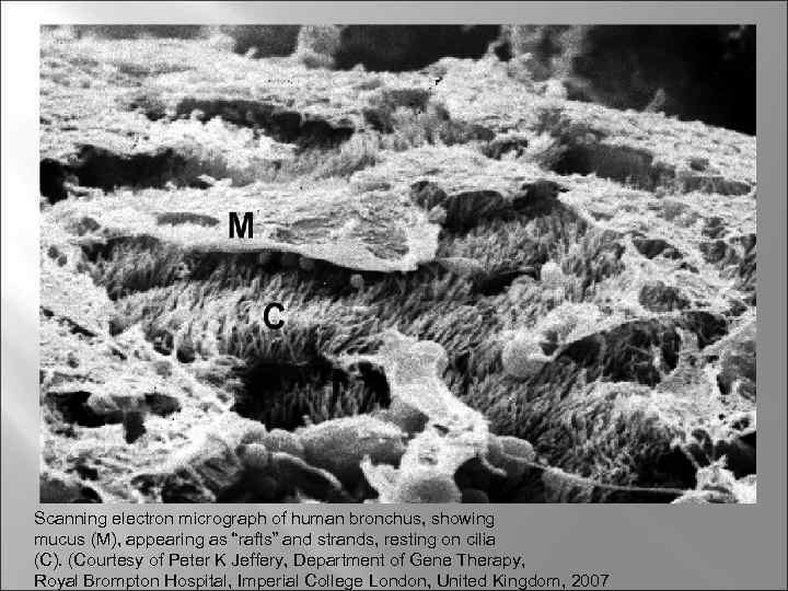 Scanning electron micrograph of human bronchus, showing mucus (M), appearing as “rafts” and strands,