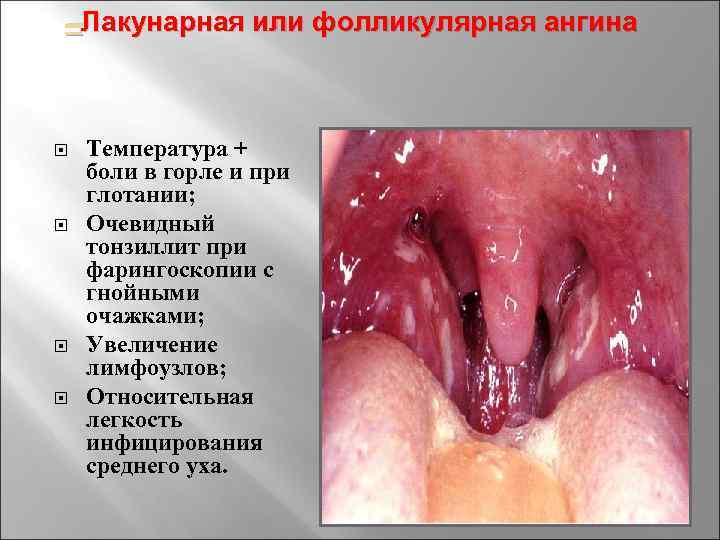Лакунарная –Лакунарная или фолликулярная ангина Температура + боли в горле и при глотании; Очевидный