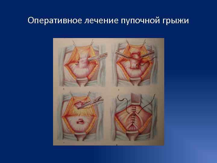 Оперативное лечение пупочной грыжи 