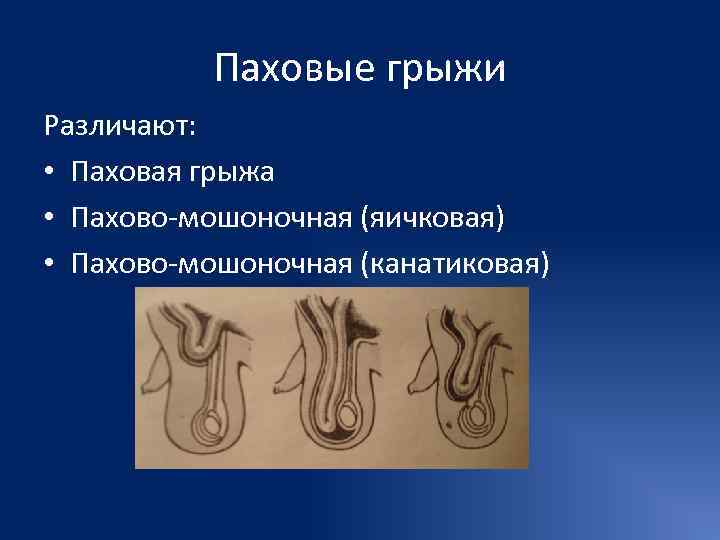   Паховые грыжи Различают:  • Паховая грыжа • Пахово-мошоночная (яичковая) • Пахово-мошоночная