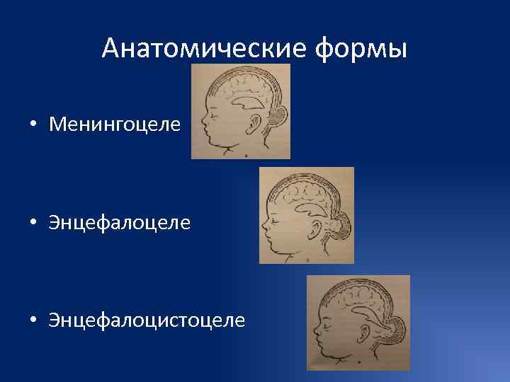  Анатомические формы  • Менингоцеле • Энцефалоцистоцеле 