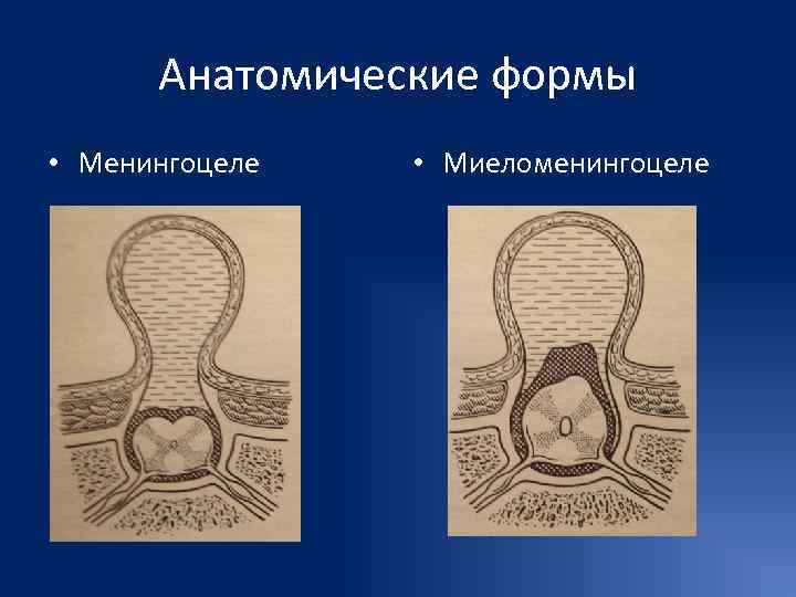  Анатомические формы • Менингоцеле  • Миеломенингоцеле 
