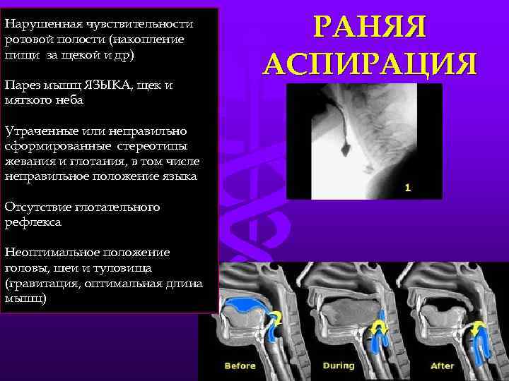 Нарушенная чувствительности ротовой полости (накопление       РАНЯЯ  