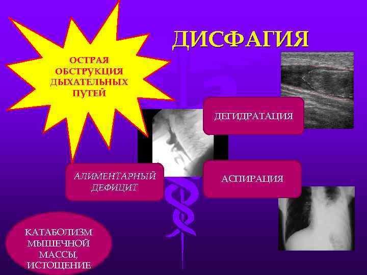      ДИСФАГИЯ  ОСТРАЯ ОБСТРУКЦИЯ  ДЫХАТЕЛЬНЫХ  ПУТЕЙ 