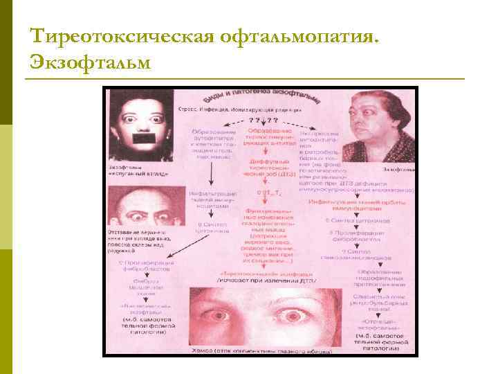 Тиреотоксическая офтальмопатия. Экзофтальм 