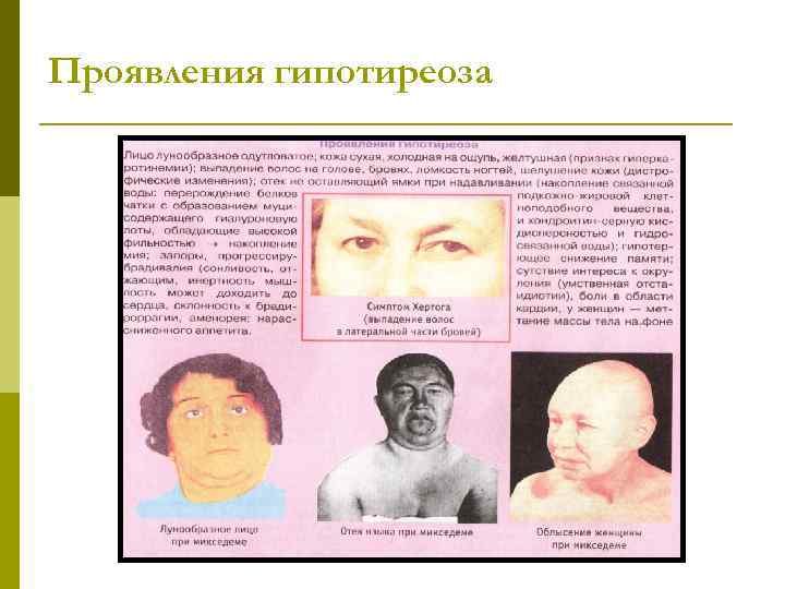 Проявления гипотиреоза 