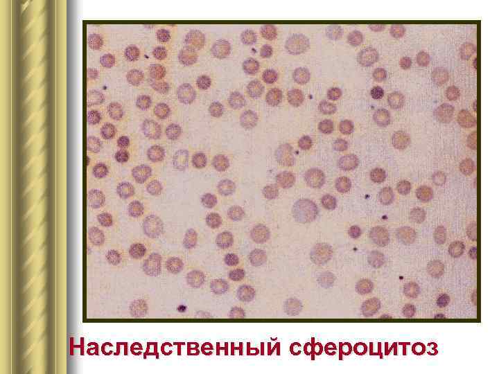 Наследственный сфероцитоз 