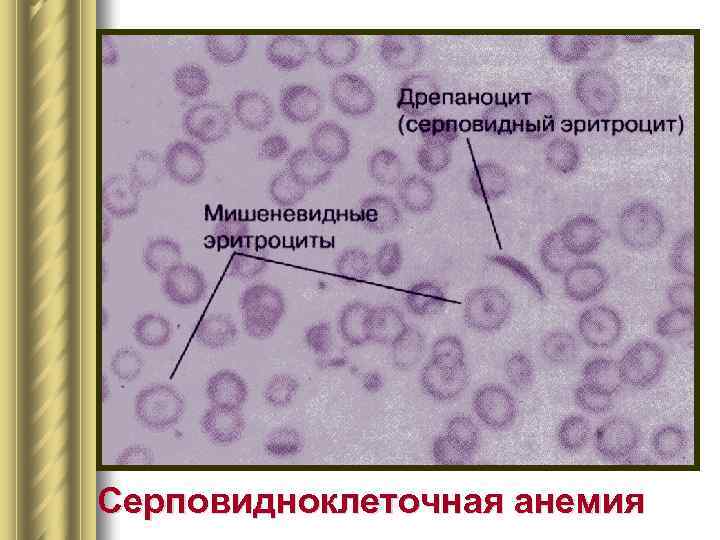 Серповидноклеточная анемия 
