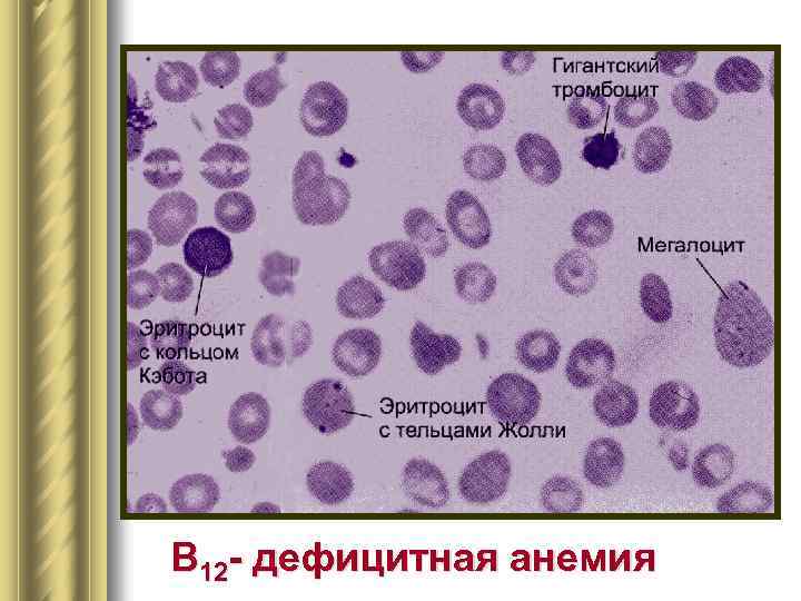 В 12 - дефицитная анемия 