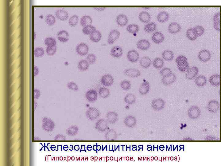 Железодефицитная анемия (Гипохромия эритроцитов, микроцитоз) 