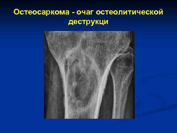 Остеосаркома - очаг остеолитической деструкци 