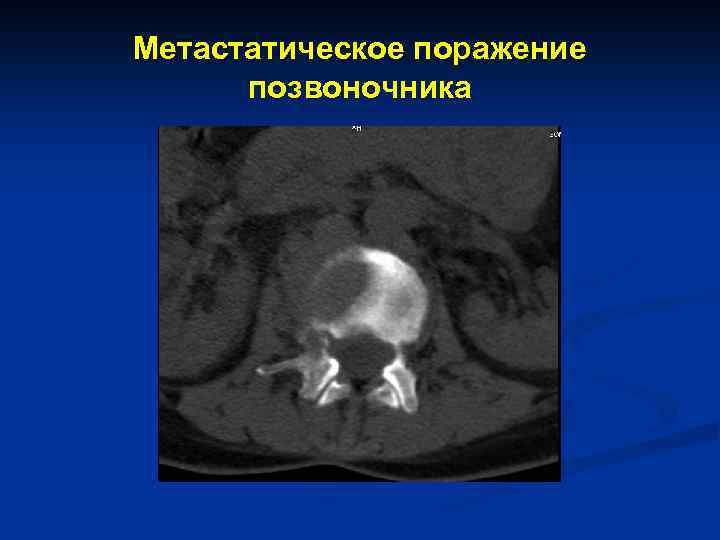 Метастатическое поражение позвоночника 