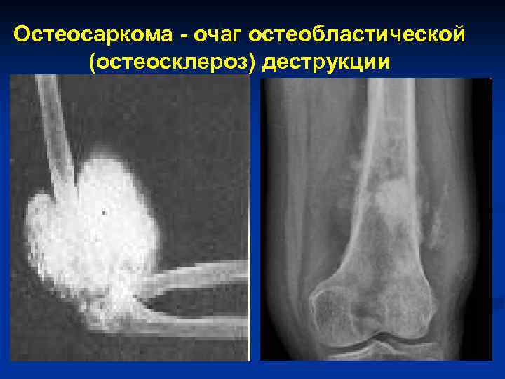 Остеосаркома - очаг остеобластической (остеосклероз) деструкции 