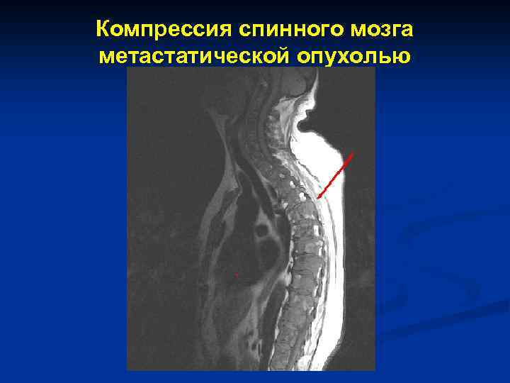 Компрессия спинного мозга метастатической опухолью 