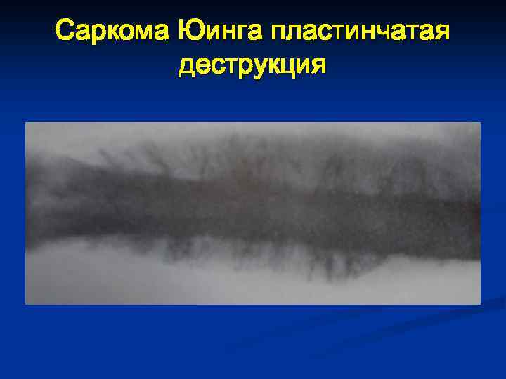 Саркома Юинга пластинчатая деструкция 