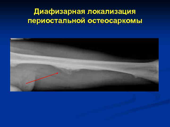 Диафизарная локализация периостальной остеосаркомы 