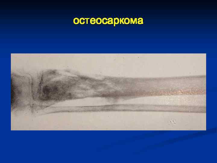 остеосаркома 