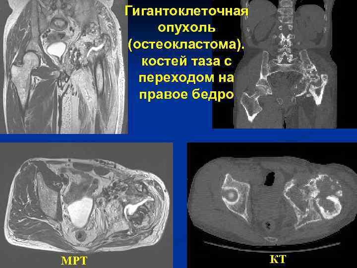 Гигантоклеточная опухоль (остеокластома). костей таза с переходом на правое бедро МРТ КТ 