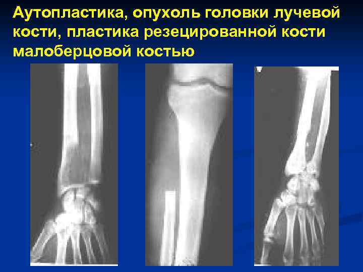 Аутопластика, опухоль головки лучевой кости, пластика резецированной кости малоберцовой костью 