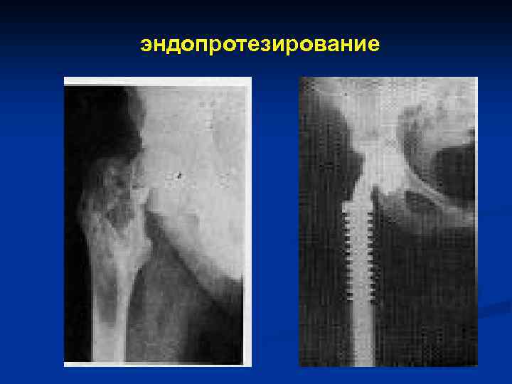эндопротезирование 