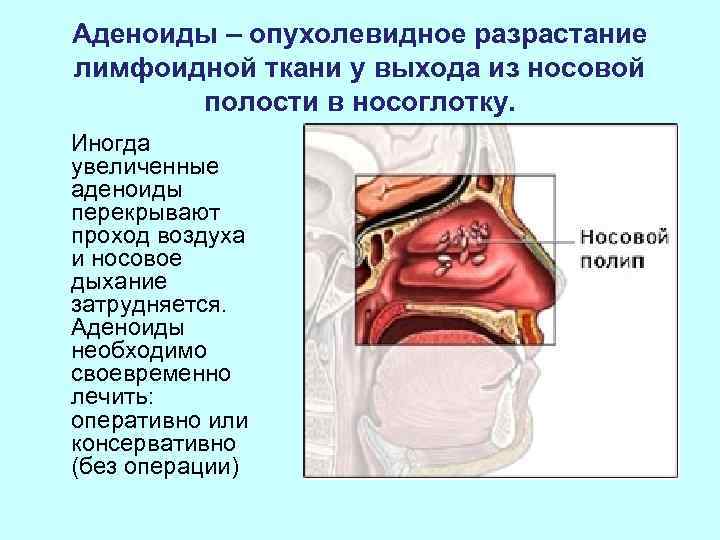 Аденоиды – опухолевидное разрастание лимфоидной ткани у выхода из носовой  полости в носоглотку.