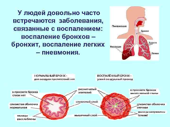  У людей довольно часто встречаются заболевания, связанные с воспалением: воспаление бронхов – бронхит,