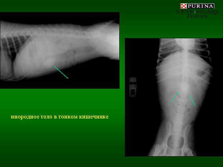 инородное тело в тонком кишечнике 