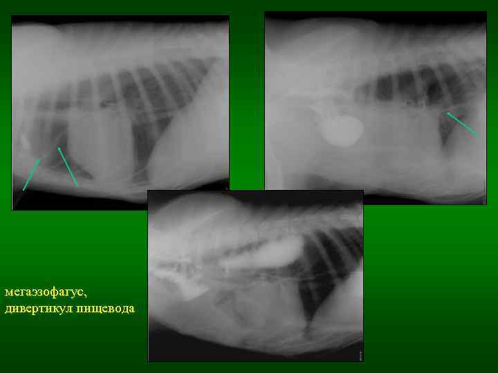 мегаэзофагус, дивертикул пищевода 