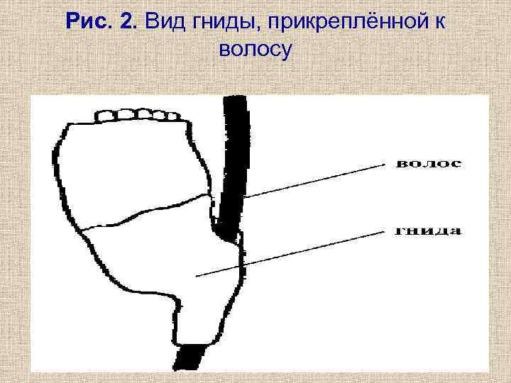 Рис. 2. Вид гниды, прикреплённой к    волосу 